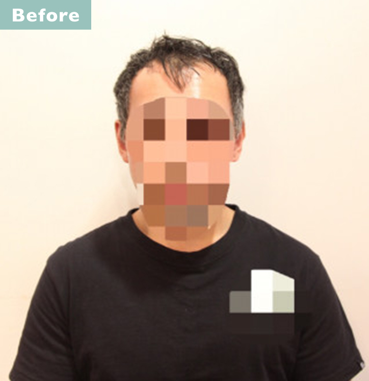 【プロが監修】薄毛をカバーできる髪型に変身!ハゲのタイプ別ヘアカタログ「前髪だけ伸びたM字ハゲ」 2番目の画像