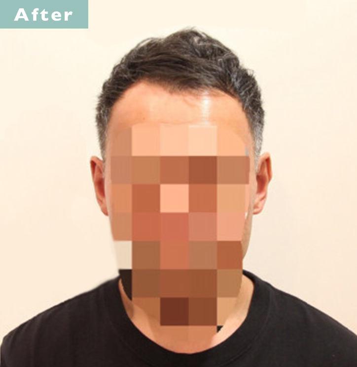 【プロが監修】薄毛をカバーできる髪型に変身!ハゲのタイプ別ヘアカタログ「前髪だけ伸びたM字ハゲ」 3番目の画像