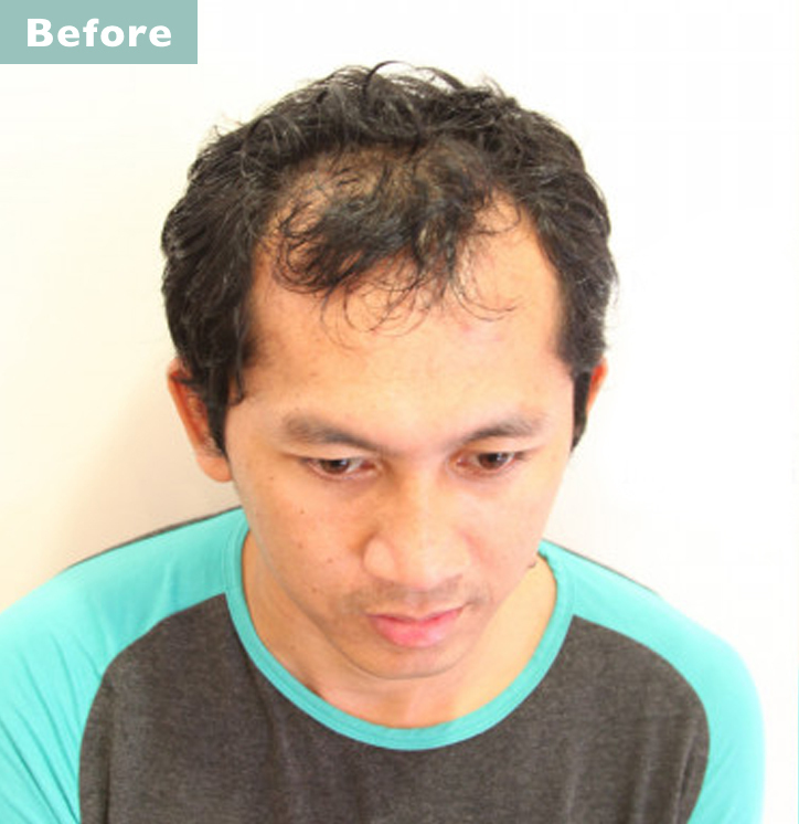【プロが監修】薄毛をカバーできる髪型に変身!ハゲのタイプ別ヘアカタログ「深いM字ハゲ」 2番目の画像