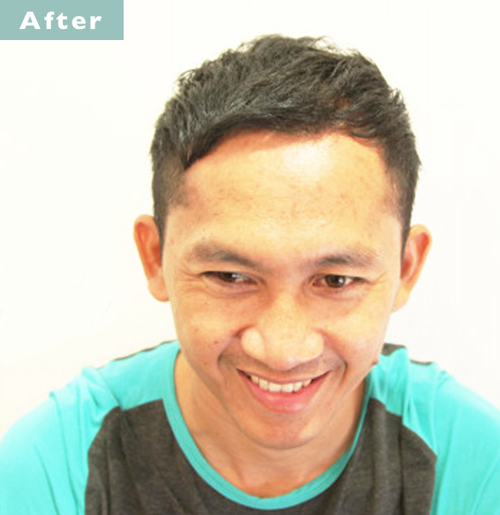 【プロが監修】薄毛をカバーできる髪型に変身!ハゲのタイプ別ヘアカタログ「深いM字ハゲ」 3番目の画像