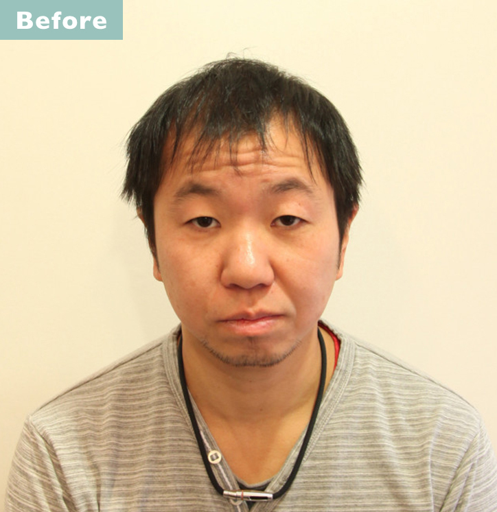 【プロが監修】薄毛をカバーできる髪型に変身!ハゲのタイプ別ヘアカタログ「全体的に薄くなった髪」 2番目の画像