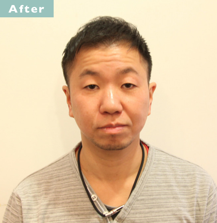 【プロが監修】薄毛をカバーできる髪型に変身!ハゲのタイプ別ヘアカタログ「全体的に薄くなった髪」 3番目の画像